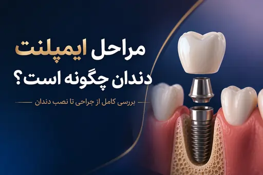 مراحل ایمپلنت دندان چگونه است؟|بررسی کامل از جراحی تا نصب دندان