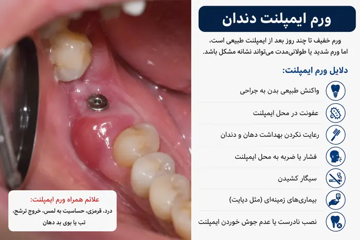 مراقبت بعد از ایمپلنت دندان