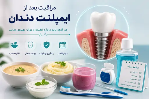 مراقبت بعد از ایمپلنت دندان؛هرآنچه باید درباره تغذیه و دوران بهبودی بدانید