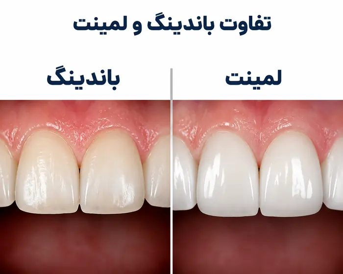 هزینه باندینگ دندان جلو ۱۴۰۵؛ قیمت هر واحد و عوامل موثر بر هزینه 5 تفاوت باندینگ و لمینت