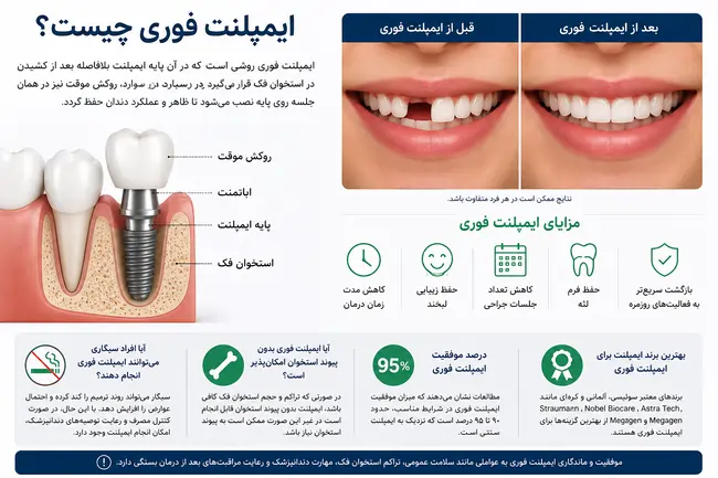 ایمپلنت فوری چیست؟ مزایا، معایب، هزینه و ماندگاری ایمپلنت فوری در سال ۱۴۰۵ 2 اینفوگرافیک ایمپلنت فوری دندان و مزایای درمان