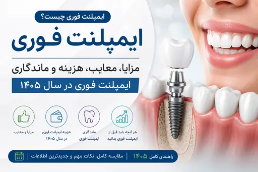ایمپلنت فوری چیست؟ مزایا، معایب، هزینه و ماندگاری ایمپلنت فوری در سال ۱۴۰۵
