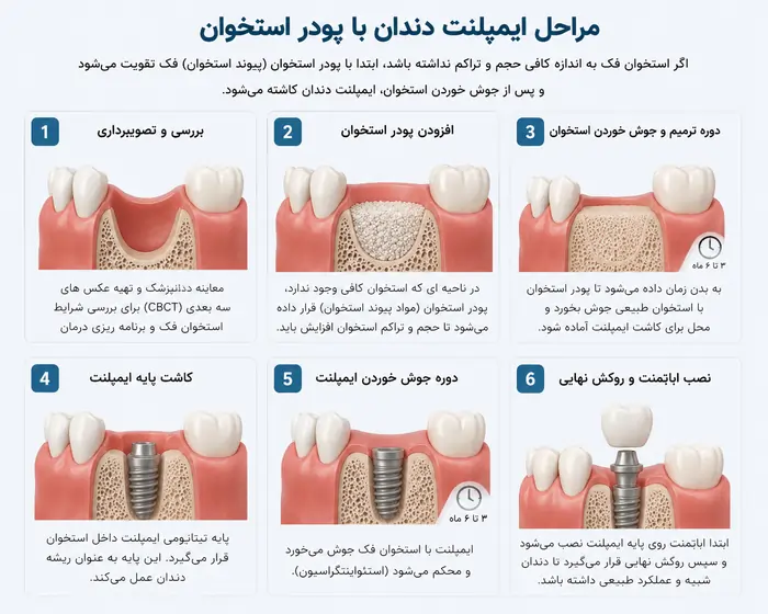 مراحل ایمپلنت دندان با پودر استخوان
