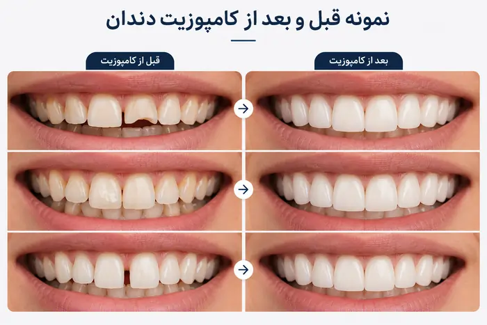نمونه قبل و بعد از کامپوزیت دندان