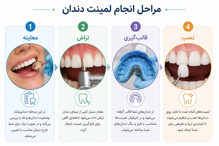 لمینت دندان چیست؟ راهنمای کامل انواع، مراحل، مزایا، معایب و ماندگاری (۱۴۰۵) 4 مراحل انجام لمینت دندان