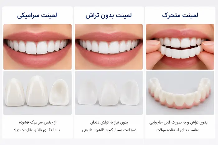 لمینت دندان چیست؟ راهنمای کامل انواع، مراحل، مزایا، معایب و ماندگاری (۱۴۰۵) 3 انواع لمینت دندان