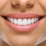 لمینت دندان