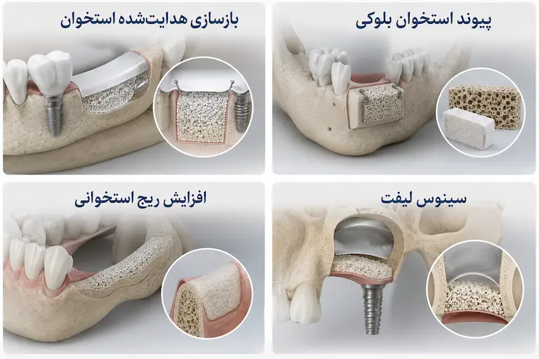 پیوند استخوان در ایمپلنت؛ چه زمانی لازم است و چقدر طول میکشد؟ 5 روش های بازسازی استخوان برای ایمپلنت