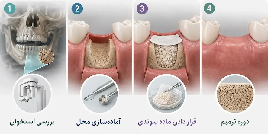 پیوند استخوان در ایمپلنت؛ چه زمانی لازم است و چقدر طول میکشد؟ 3 مراحل پیوند استخوان برای ایمپلنت