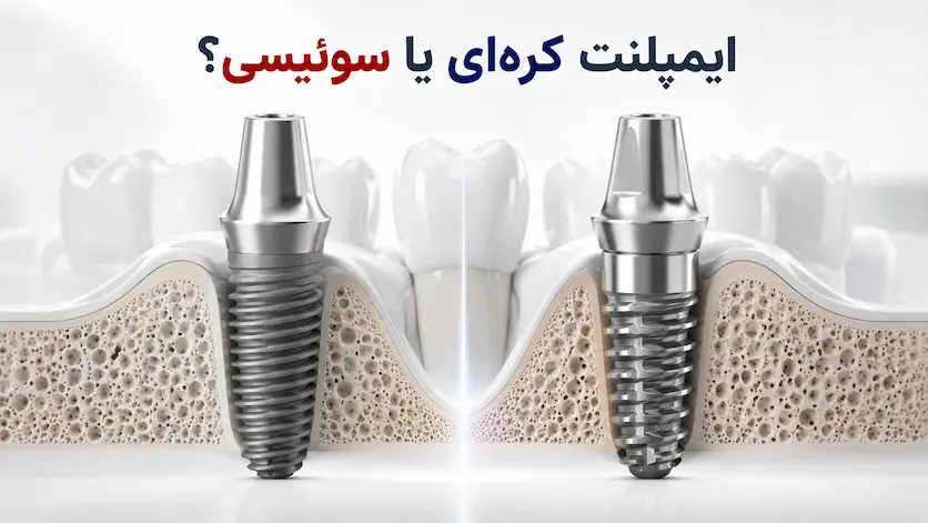 ایمپلنت کره ای یا سوئیسی؟ تفاوت‌ها و نکاتی که قبل از انتخاب باید بدانید