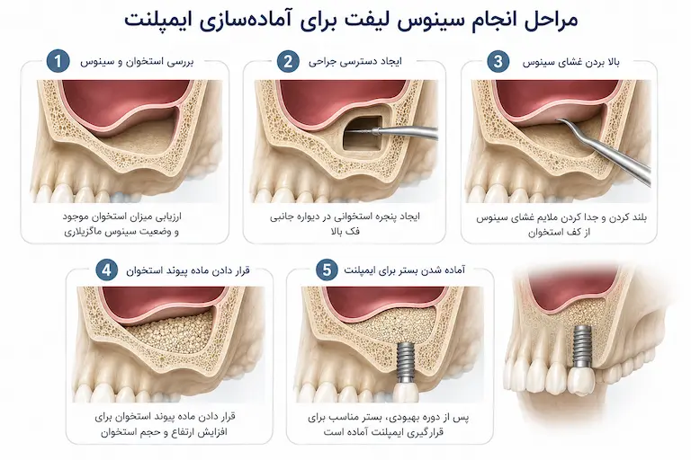 مراحل انجام سینوس لیفت برای ایمپلنت