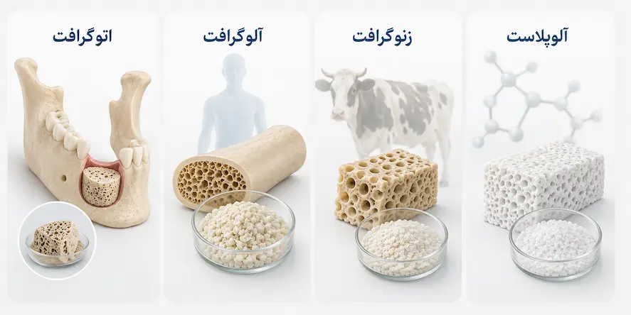 پیوند استخوان در ایمپلنت؛ چه زمانی لازم است و چقدر طول میکشد؟ 4 انواع مواد پیوند استخوان شامل اتوگرافت آلوگرافت زنوگرافت و آلوپلاست
