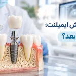 زمان روکش ایمپلنت