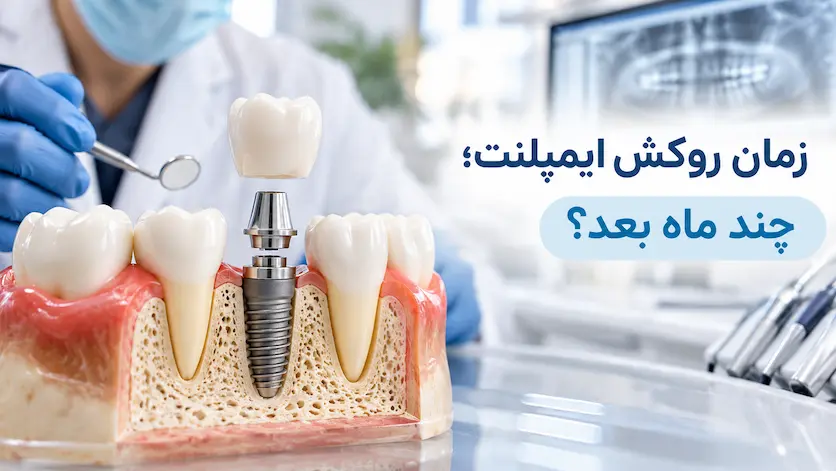 زمان روکش ایمپلنت؛ چه زمانی روکش ایمپلنت گذاشته میشود؟ زمان روکش ایمپلنت؛ چه زمانی روکش ایمپلنت گذاشته میشود؟