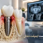 علت شکست ایمپلنت دندان و بررسی وضعیت ایمپلنت و استخوان فک
