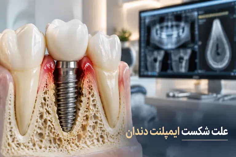 علت شکست ایمپلنت دندان چیست؟ علائم، دلایل و راه درمان علت شکست ایمپلنت دندان چیست؟ علائم، دلایل و راه درمان